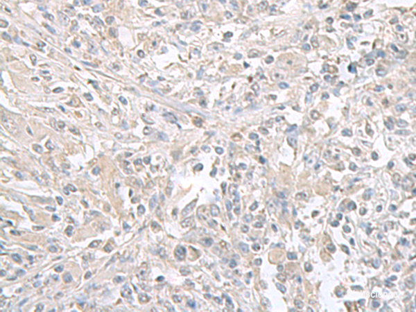 Immunohistochemistry of paraffin-embedded Human liver cancer tissue  using FXYD6 Polyclonal Antibody at dilution of 1:65(×200)