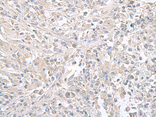 Immunohistochemistry of paraffin-embedded Human liver cancer tissue  using FXYD6 Polyclonal Antibody at dilution of 1:65(×200)