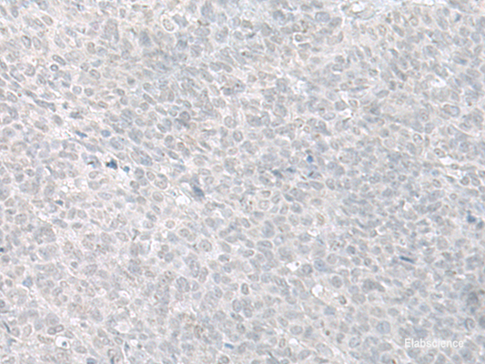 Immunohistochemistry of paraffin-embedded Human ovarian cancer tissue  using C8orf4 Polyclonal Antibody at dilution of 1:70(×200)