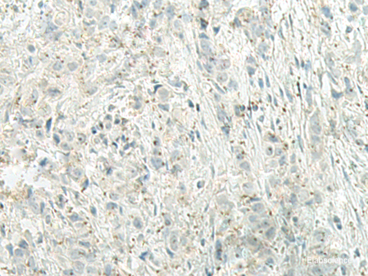 Immunohistochemistry of paraffin-embedded Human breast cancer tissue  using UQCC2 Polyclonal Antibody at dilution of 1:60(×200)