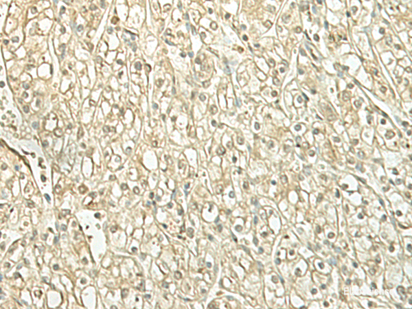 Immunohistochemistry of paraffin-embedded Human kidney cancer tissue  using SPIRE1 Polyclonal Antibody at dilution of 1:60(×200)