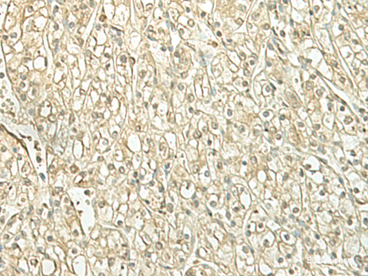 Immunohistochemistry of paraffin-embedded Human kidney cancer tissue  using SPIRE1 Polyclonal Antibody at dilution of 1:60(×200)