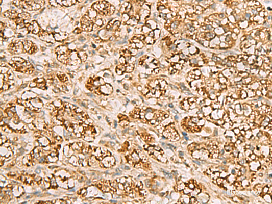 Immunohistochemistry of paraffin-embedded Human liver cancer tissue  using MTAP Polyclonal Antibody at dilution of 1:70(×200)