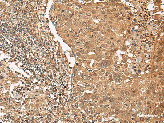 Immunohistochemistry of paraffin-embedded Human cervical cancer tissue  using TIPRL Polyclonal Antibody at dilution of 1:65(×200)