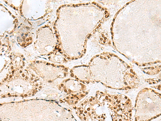 Immunohistochemistry of paraffin-embedded Human thyroid cancer tissue  using GTF3C2 Polyclonal Antibody at dilution of 1:45(×200)