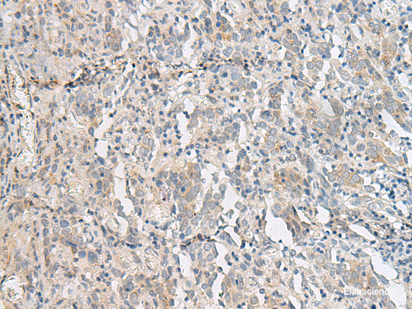Immunohistochemistry of paraffin-embedded Human cervical cancer tissue  using PCSK5 Polyclonal Antibody at dilution of 1:50(×200)