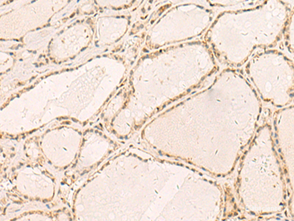 Immunohistochemistry of paraffin-embedded Human thyroid cancer tissue  using RFX6 Polyclonal Antibody at dilution of 1:50(×200)
