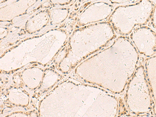 Immunohistochemistry of paraffin-embedded Human thyroid cancer tissue  using RFX6 Polyclonal Antibody at dilution of 1:50(×200)