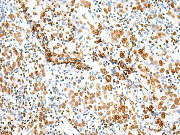 Immunohistochemistry of paraffin-embedded Human cervical cancer tissue  using TCOF1 Polyclonal Antibody at dilution of 1:50(×200)