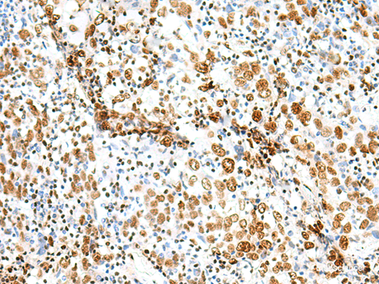 Immunohistochemistry of paraffin-embedded Human cervical cancer tissue  using TCOF1 Polyclonal Antibody at dilution of 1:50(×200)