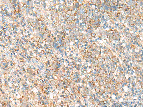 Immunohistochemistry of paraffin-embedded Human cervical cancer tissue  using PSD4 Polyclonal Antibody at dilution of 1:50(×200)