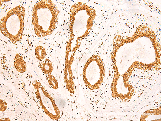 Immunohistochemistry of paraffin-embedded Human breast cancer tissue  using ZNF471 Polyclonal Antibody at dilution of 1:50(×200)