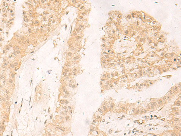 Immunohistochemistry of paraffin-embedded Human liver cancer tissue  using RBX1 Polyclonal Antibody at dilution of 1:30(×200)
