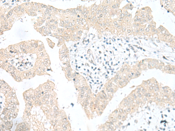 Immunohistochemistry of paraffin-embedded Human liver cancer tissue  using SNRPD1 Polyclonal Antibody at dilution of 1:30(×200)