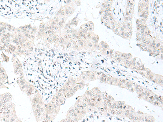 Immunohistochemistry of paraffin-embedded Human liver cancer tissue  using ENSA Polyclonal Antibody at dilution of 1:70(×200)