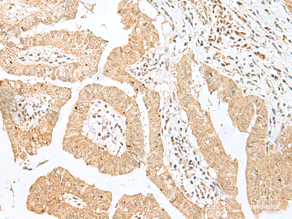 Immunohistochemistry of paraffin-embedded Human liver cancer tissue  using BEX2 Polyclonal Antibody at dilution of 1:50(×200)