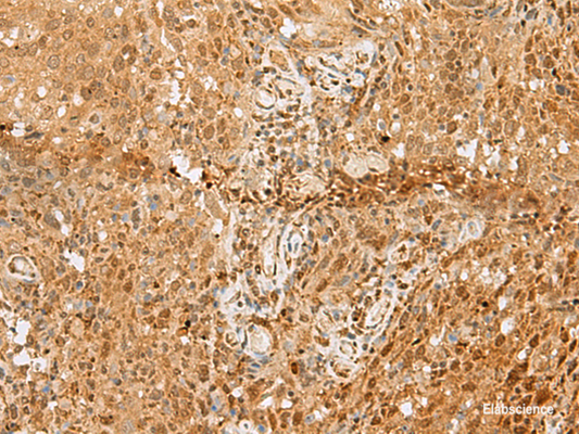 Immunohistochemistry of paraffin-embedded Human cervical cancer tissue  using PNRC2 Polyclonal Antibody at dilution of 1:50(×200)