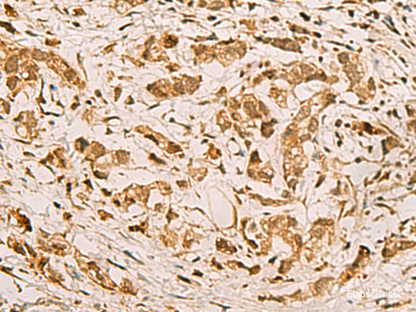 Immunohistochemistry of paraffin-embedded Human gastric cancer tissue  using ZMAT4 Polyclonal Antibody at dilution of 1:65(×200)