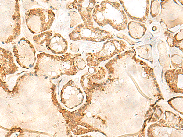 Immunohistochemistry of paraffin-embedded Human thyroid cancer tissue  using JPT1 Polyclonal Antibody at dilution of 1:35(×200)
