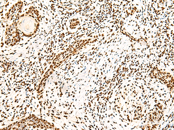 Immunohistochemistry of paraffin-embedded Human esophagus cancer tissue  using ILF3 Polyclonal Antibody at dilution of 1:40(×200)
