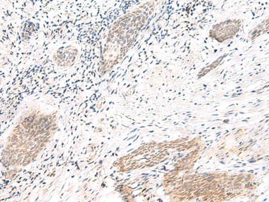 Immunohistochemistry of paraffin-embedded Human esophagus cancer tissue  using ARL2BP Polyclonal Antibody at dilution of 1:50(×200)