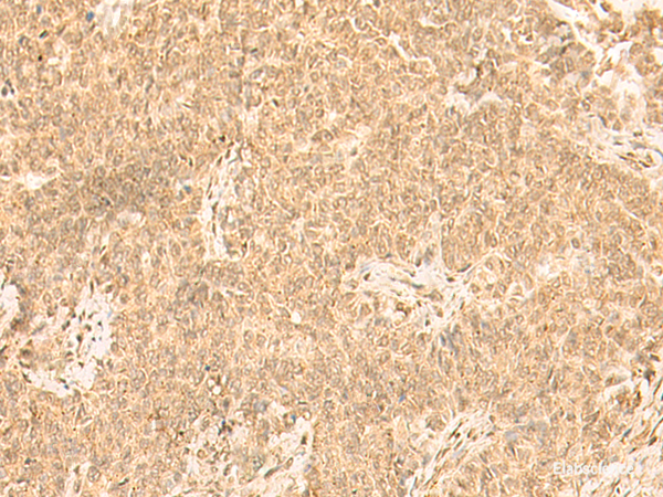 Immunohistochemistry of paraffin-embedded Human ovarian cancer tissue  using ST8SIA4 Polyclonal Antibody at dilution of 1:50(×200)