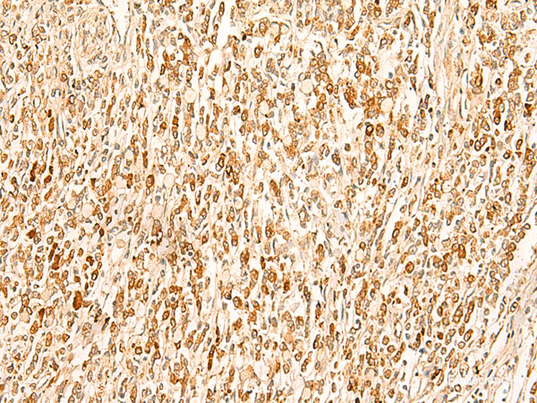 Immunohistochemistry of paraffin-embedded Human gastric cancer tissue  using SMUG1 Polyclonal Antibody at dilution of 1:50(×200)