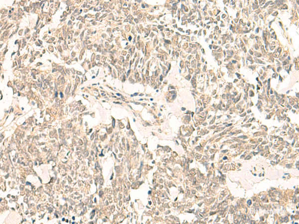 Immunohistochemistry of paraffin-embedded Human lung cancer tissue  using GINS2 Polyclonal Antibody at dilution of 1:50(×200)