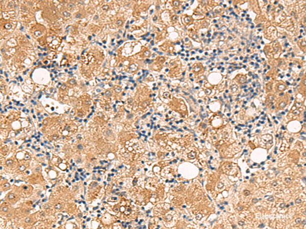 Immunohistochemistry of paraffin-embedded Human liver cancer tissue  using FUNDC2 Polyclonal Antibody at dilution of 1:60(×200)