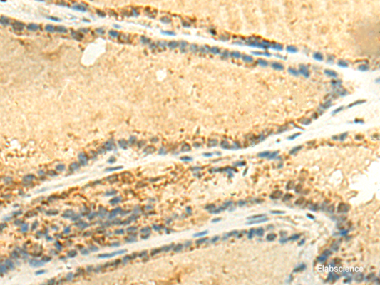 Immunohistochemistry of paraffin-embedded Human thyroid cancer tissue  using EEF1AKMT2 Polyclonal Antibody at dilution of 1:50(×200)