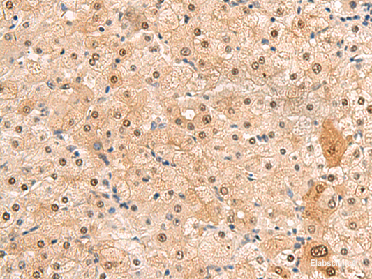 Immunohistochemistry of paraffin-embedded Human liver cancer tissue  using HEBP2 Polyclonal Antibody at dilution of 1:60(×200)