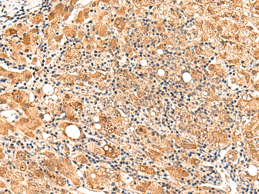 Immunohistochemistry of paraffin-embedded Human liver cancer tissue  using PAFAH1B2 Polyclonal Antibody at dilution of 1:50(×200)