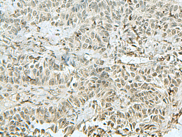 Immunohistochemistry of paraffin-embedded Human ovarian cancer tissue  using THTPA Polyclonal Antibody at dilution of 1:90(×200)