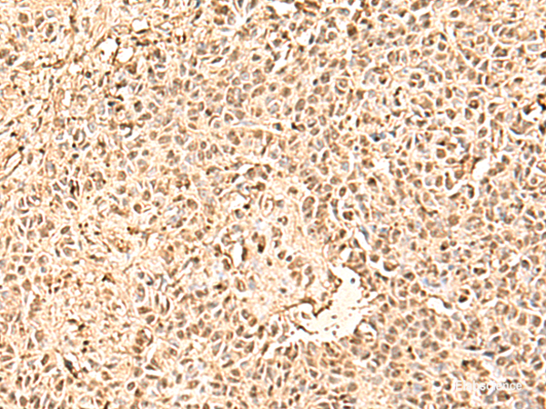 Immunohistochemistry of paraffin-embedded Human ovarian cancer tissue  using SMNDC1 Polyclonal Antibody at dilution of 1:50(×200)