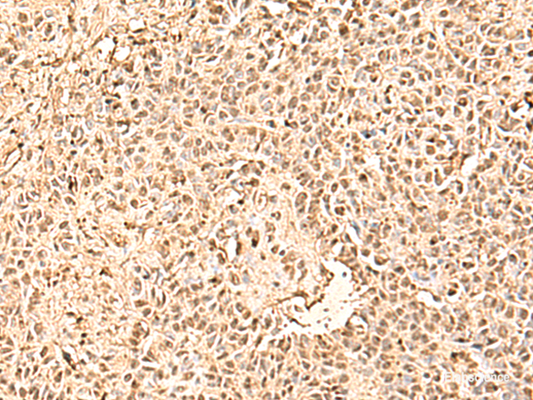 Immunohistochemistry of paraffin-embedded Human ovarian cancer tissue  using SMNDC1 Polyclonal Antibody at dilution of 1:50(×200)