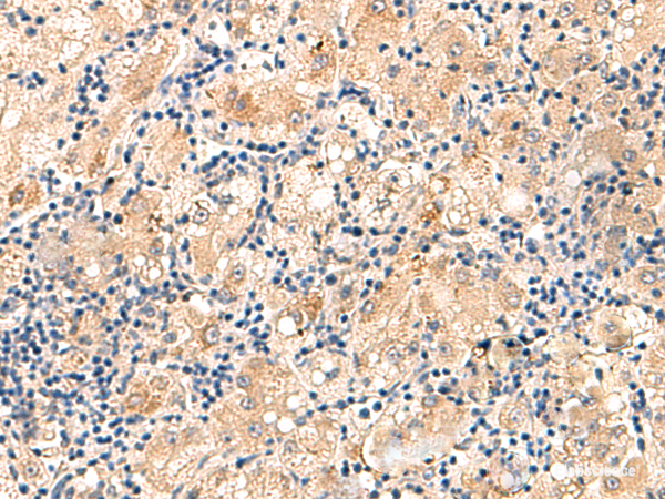 Immunohistochemistry of paraffin-embedded Human liver cancer tissue  using MRPL16 Polyclonal Antibody at dilution of 1:60(×200)