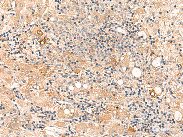 Immunohistochemistry of paraffin-embedded Human liver cancer tissue  using SULT4A1 Polyclonal Antibody at dilution of 1:50(×200)