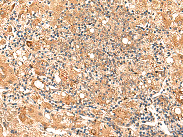 Immunohistochemistry of paraffin-embedded Human liver cancer tissue  using GALNT12 Polyclonal Antibody at dilution of 1:70(×200)