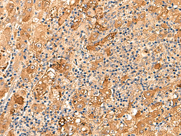 Immunohistochemistry of paraffin-embedded Human liver cancer tissue  using KCNE3 Polyclonal Antibody at dilution of 1:60(×200)