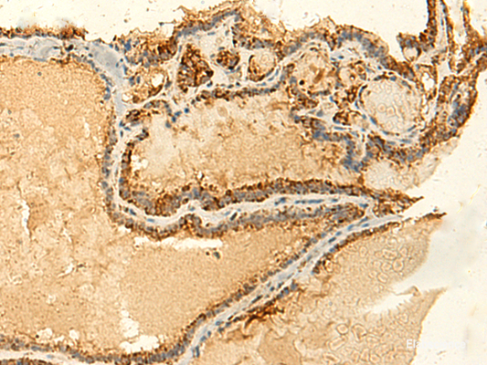 Immunohistochemistry of paraffin-embedded Human thyroid cancer tissue  using GLYATL2 Polyclonal Antibody at dilution of 1:50(×200)