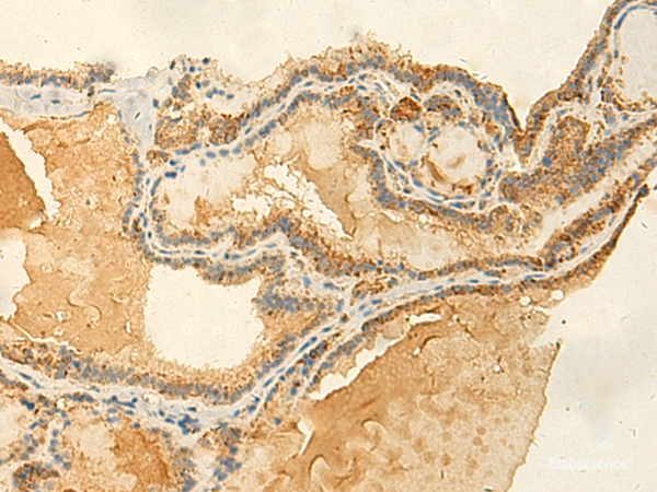 Immunohistochemistry of paraffin-embedded Human thyroid cancer tissue  using RNF148 Polyclonal Antibody at dilution of 1:50(×200)