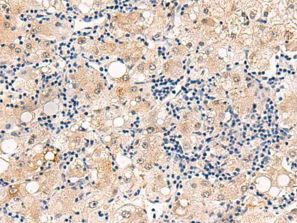 Immunohistochemistry of paraffin-embedded Human liver cancer tissue  using DUSP7 Polyclonal Antibody at dilution of 1:50(×200)