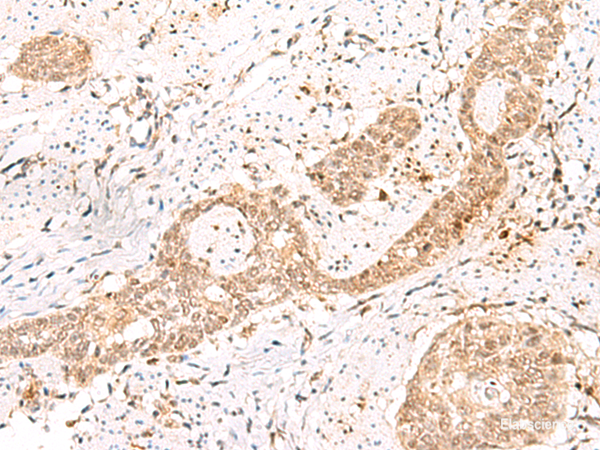 Immunohistochemistry of paraffin-embedded Human esophagus cancer tissue  using PRKAG2 Polyclonal Antibody at dilution of 1:55(×200)
