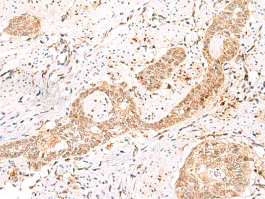 Immunohistochemistry of paraffin-embedded Human esophagus cancer tissue  using PRKAG2 Polyclonal Antibody at dilution of 1:55(×200)