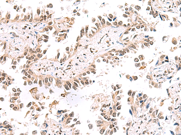 Immunohistochemistry of paraffin-embedded Human lung cancer tissue  using KCTD13 Polyclonal Antibody at dilution of 1:50(×200)