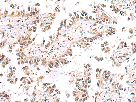Immunohistochemistry of paraffin-embedded Human lung cancer tissue  using KCTD13 Polyclonal Antibody at dilution of 1:50(×200)