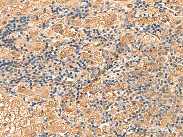 Immunohistochemistry of paraffin-embedded Human liver cancer tissue  using PTH1R Polyclonal Antibody at dilution of 1:55(×200)