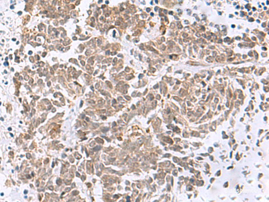 Immunohistochemistry of paraffin-embedded Human lung cancer tissue  using RBFOX2 Polyclonal Antibody at dilution of 1:50(×200)