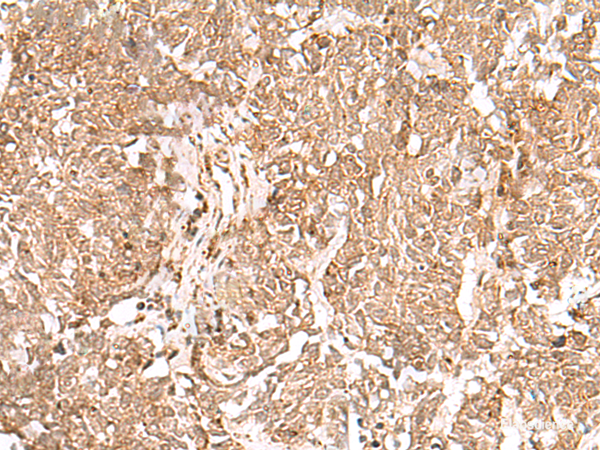 Immunohistochemistry of paraffin-embedded Human lung cancer tissue  using GMPPB Polyclonal Antibody at dilution of 1:50(×200)