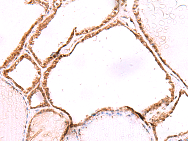 Immunohistochemistry of paraffin-embedded Human thyroid cancer tissue  using LMCD1 Polyclonal Antibody at dilution of 1:80(×200)